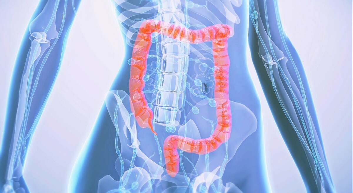 El oncólogo Diego Alcazar (GenesisCare): " Los síntomas del cáncer colorrectal se confunden con problemas digestivos comunes"
