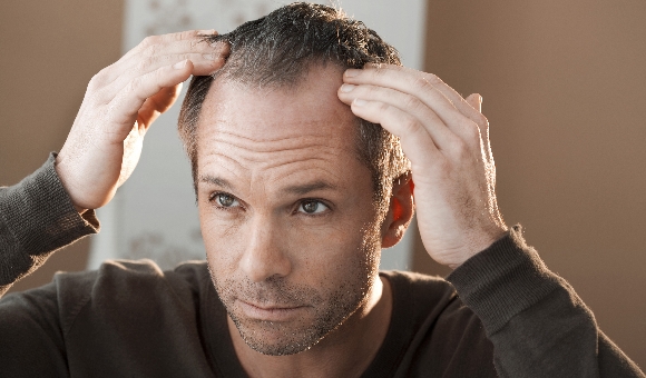 alopecia-getty.jpg