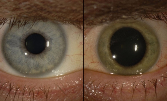 ebola-ojos-paciente-emory-eyes-center.jpg