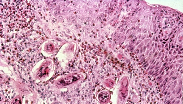 esquistosomiasis urinaria
