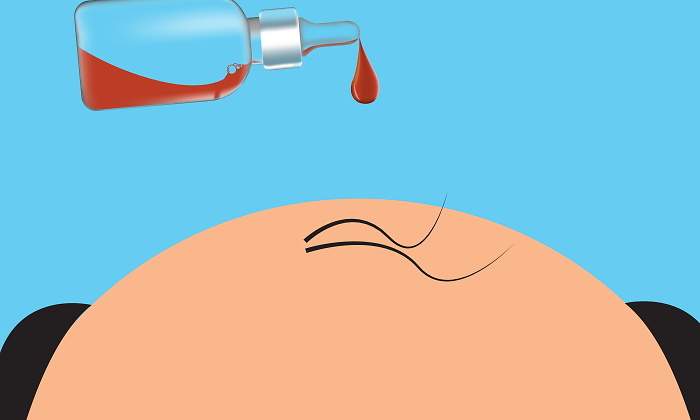 injerto-capilar-protesis-capilar-tratamiento-alopecia-dreamstime.jpg