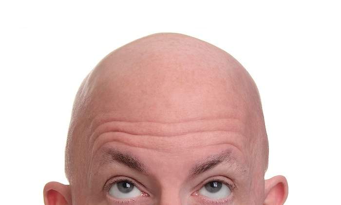 Una-persona-sin-pelo-mostrando-la-parte-superior-de-su-casa-iStock.jpg