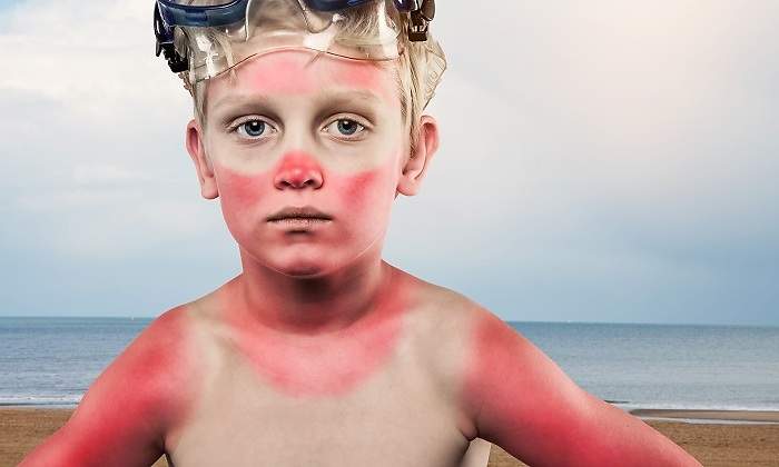 Nino-con-quemaduras-por-el-sol-iStock.jpg