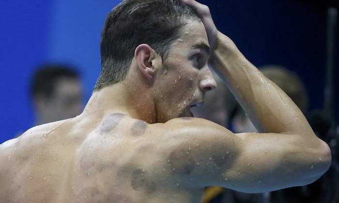 Phelps-cupping-manchas-2016-reuters.jpg