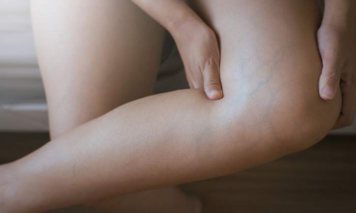 varices-dreamstime.jpg