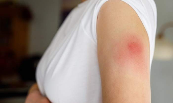 dolor-brazo-vacuna-covid-19.jpg