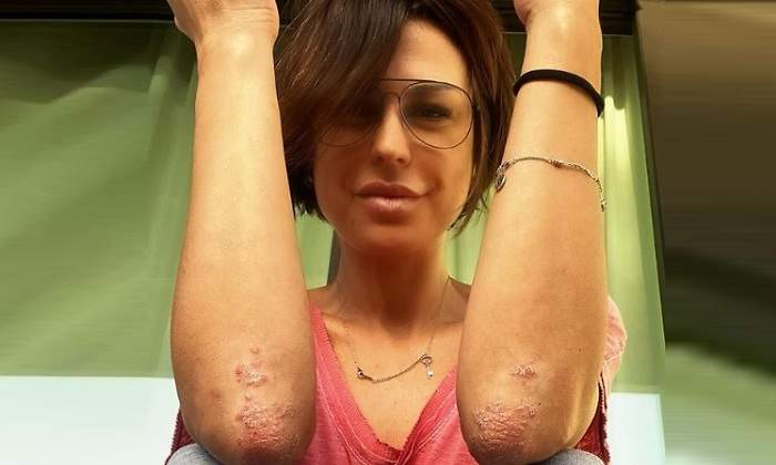 raquel-perera-psoriasis-770.jpg