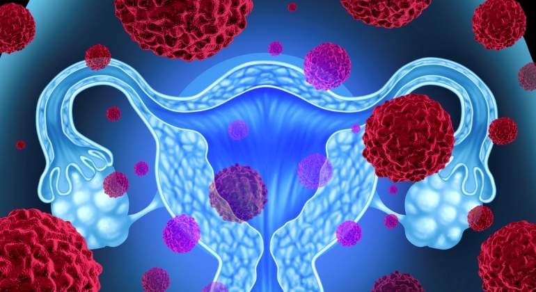 Sintomas cancer utero y ovario