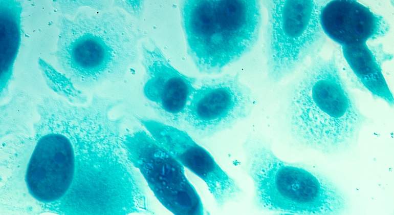 varias opciones de tratamiento para el cáncer de próstata