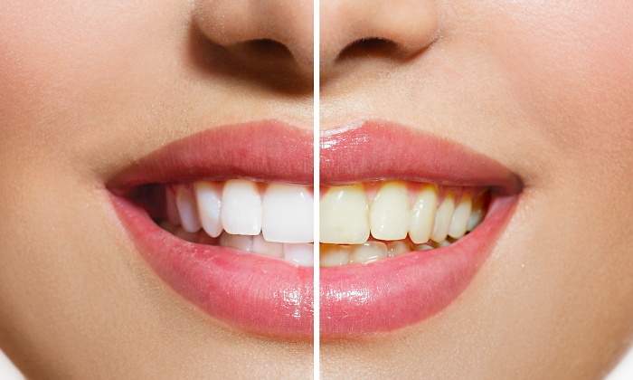 dientes-blancos-770.jpg