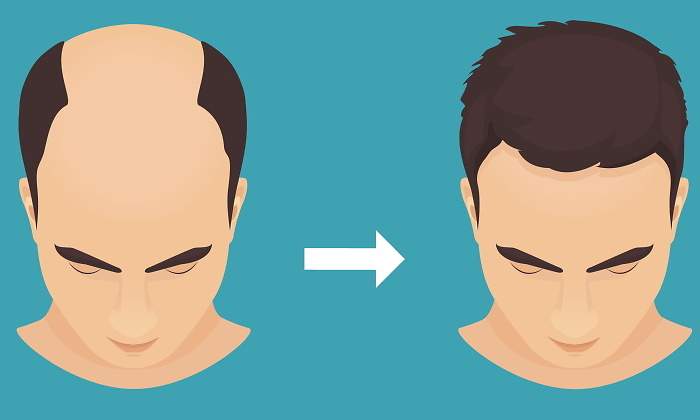 injerto-capilar-tecnica-fue-minoxidil-calvo-espana.jpg