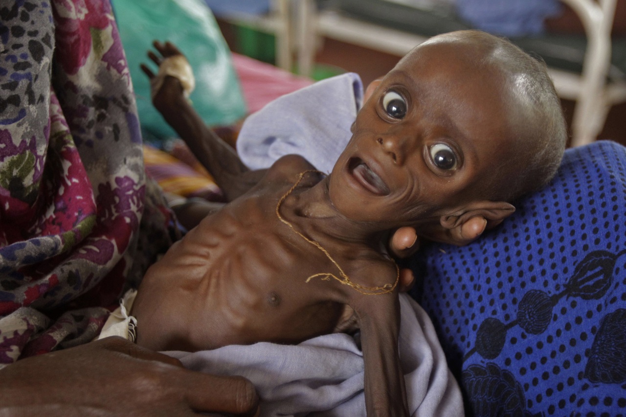 Hambruna en Somalia